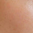 Normal skin