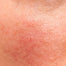 Sensitive skin